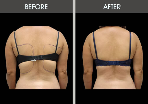 Back Liposuction Before and After Gallery