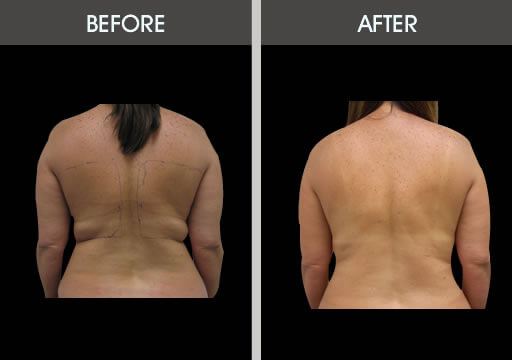 Back Liposuction Before and After Gallery